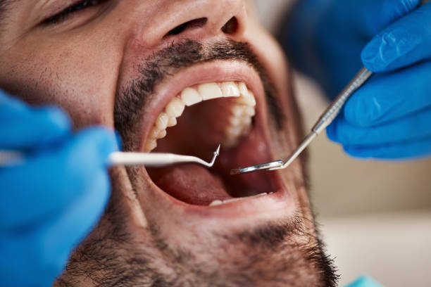 Best Emergency Tooth Extraction in Redland, TX